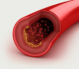 CRP levels, inflammation and heart disease